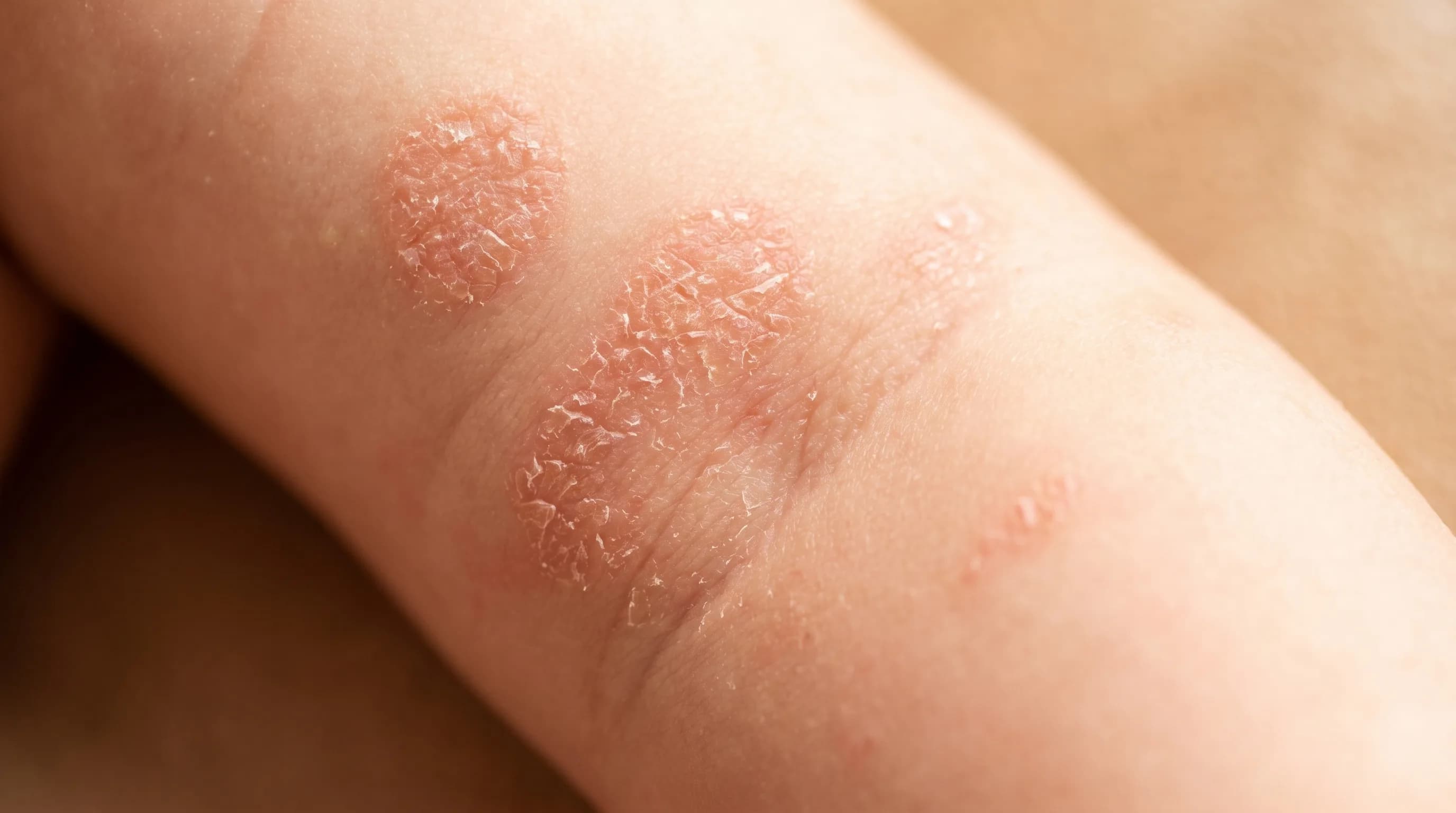 Dry patches on a baby's sensitive skin