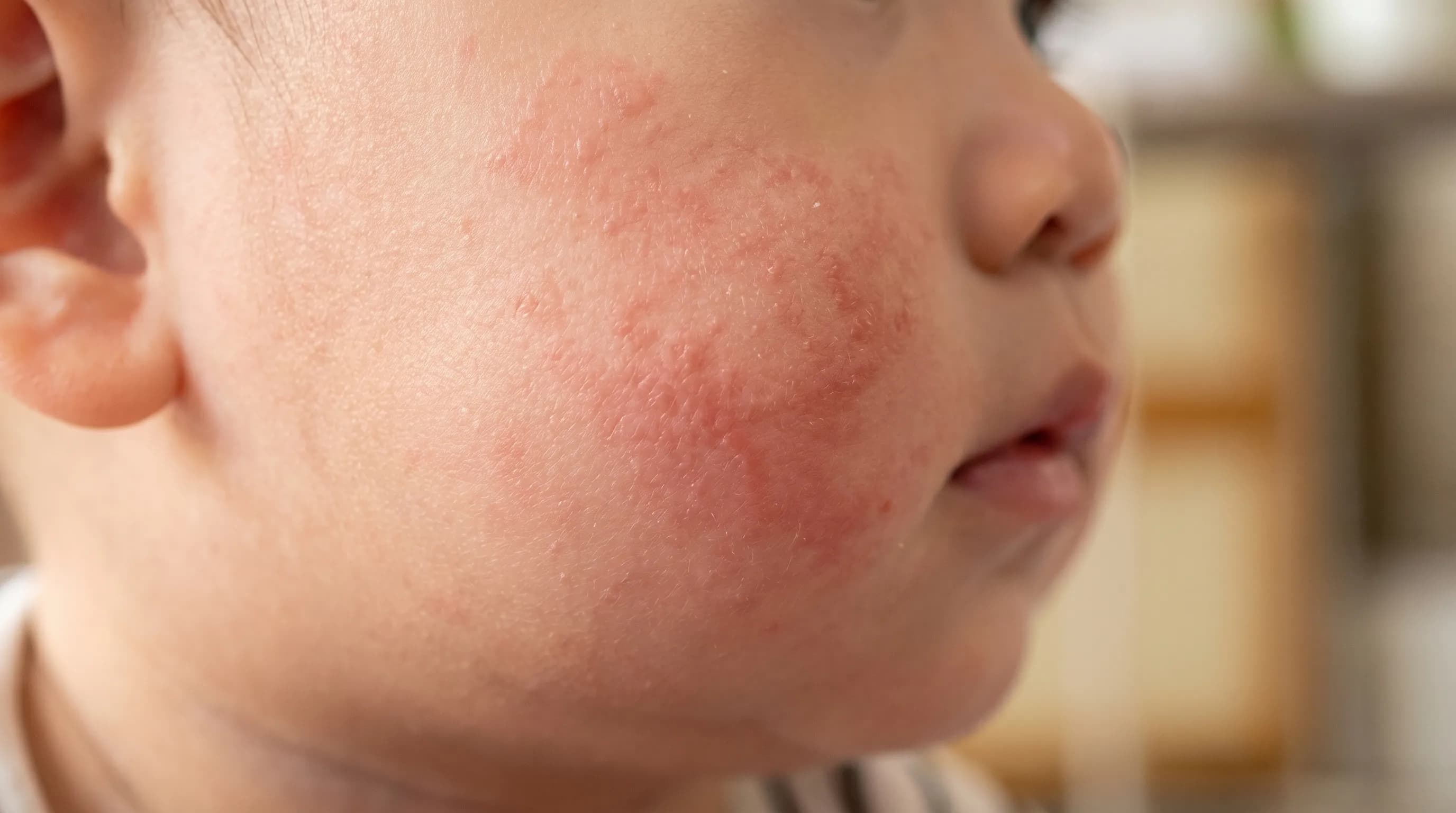 Unexpected redness on a child's skin